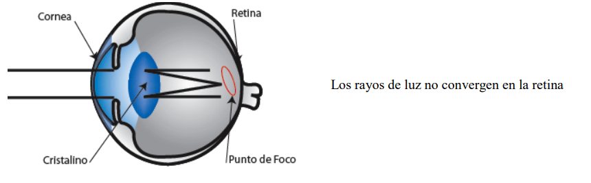 Esquema de un ojo con astigmatismo: los rayos de luz no convergen en un único punto de la retina