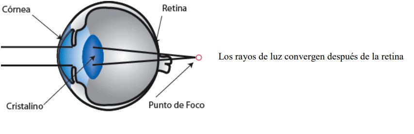 Esquema de un ojo hipermétrope: los rayos de luz convergen por detrás de la retina