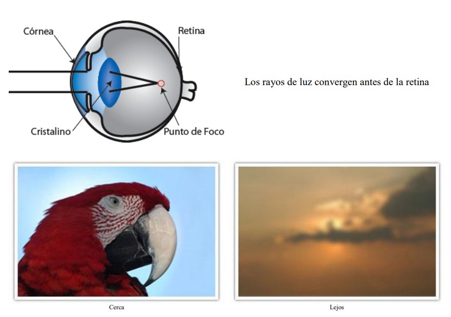 Esquema de un ojo miope: los rayos de luz convergen antes de llegar a la retina